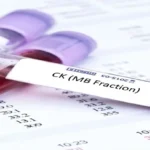 Creatinine Kinase-MB (CK-MB) Test