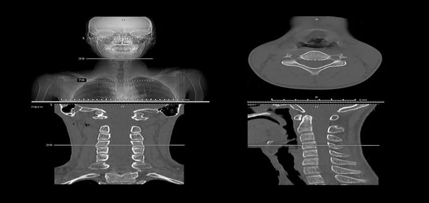 CT scan of the neck
